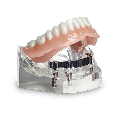 Overdenture