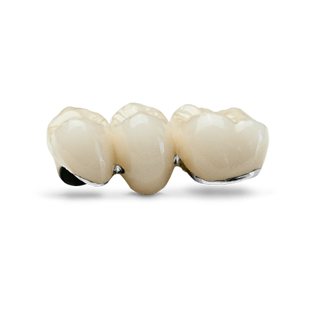 Porcelain-Fused-to-Metal